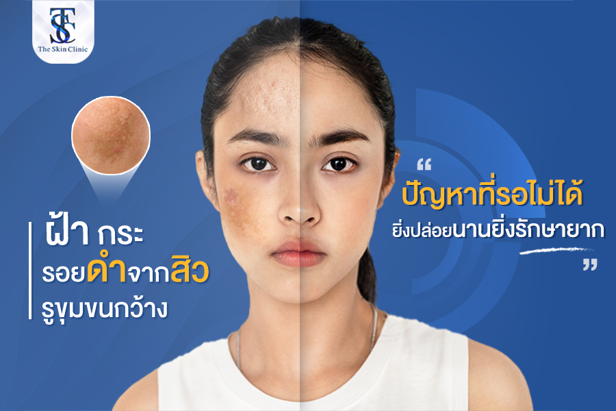 ฝ้า กระ รอยดำสิว