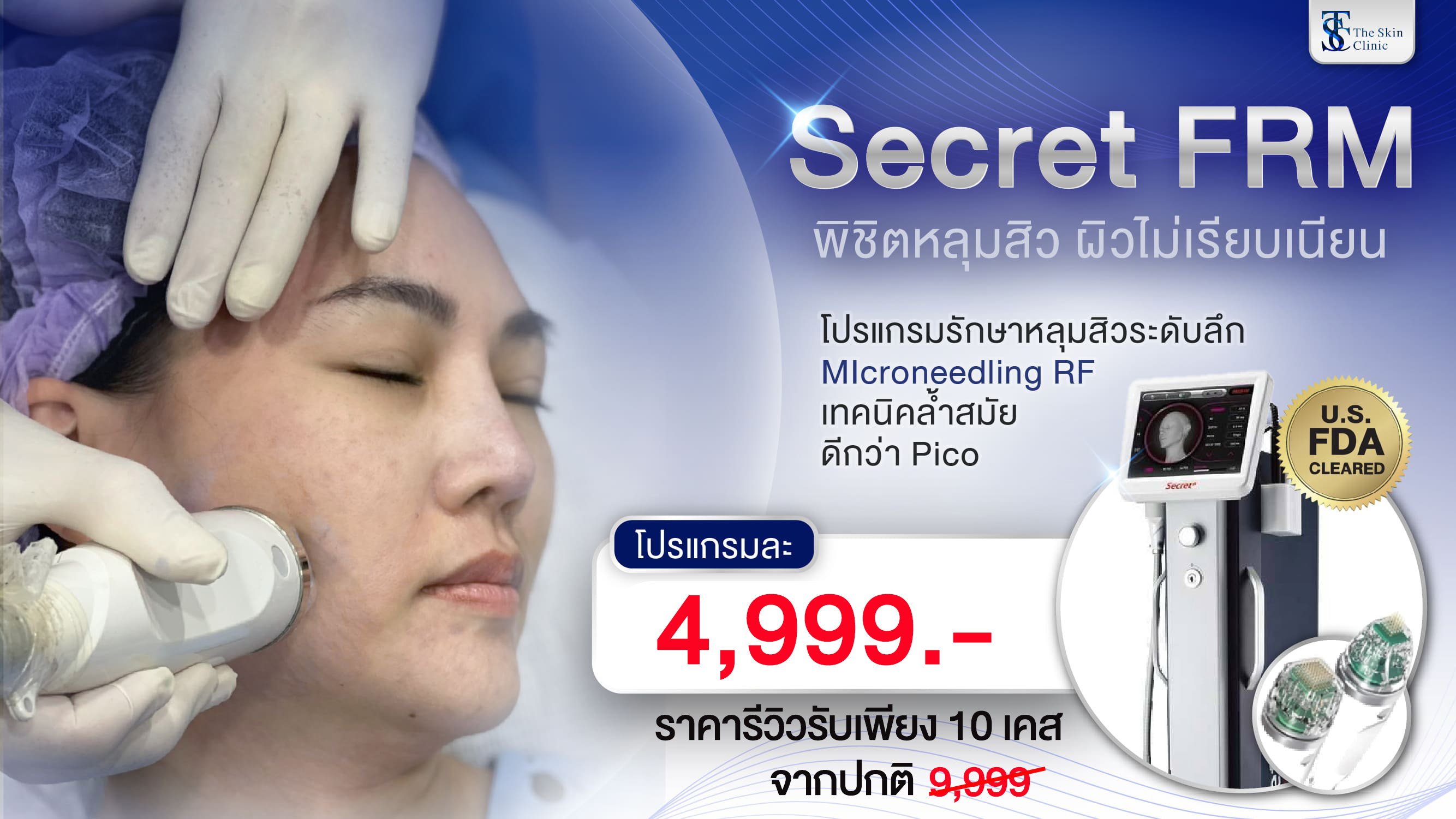 โปรโมชั่นเลเซอร์รักษาหลุมสิว